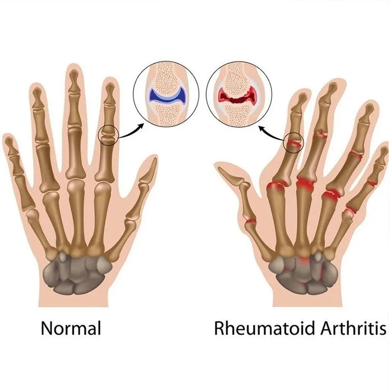 Arthritis Pressure Gloves - Pain Relief Gloves